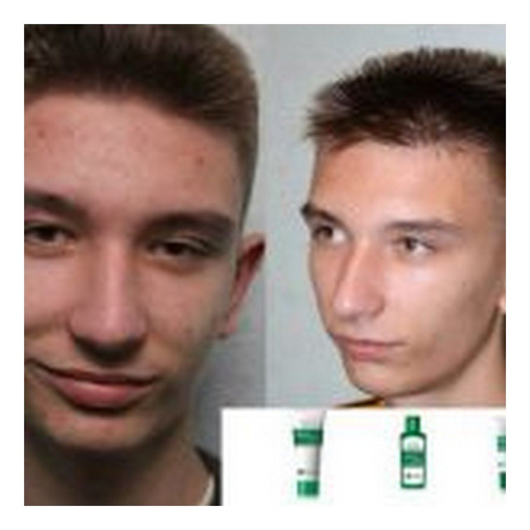 Krém proti akné a jazvám - Master Herb / tianDe