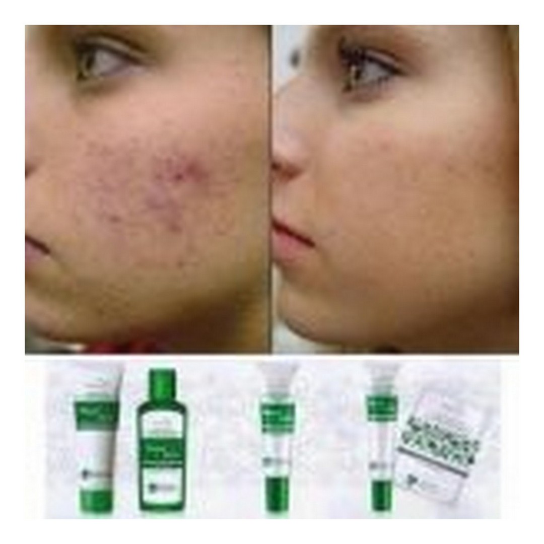 Gél na akné BioComplex - Master Herb / tianDe